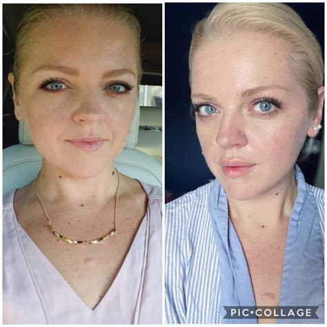 Juvederm Lip Fillers Before And After Second Time After 6 Months 1