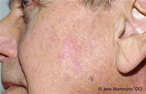 Actinic Keratosis Skin Spots Skin Cancer Pictures Scaly Skin
