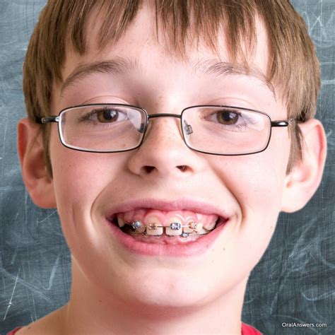Orthodontics And Braces Oral Answers