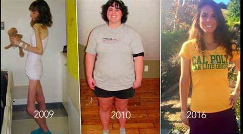 Finding Balance After Extreme Anorexia And Dangerous Binging Muscle