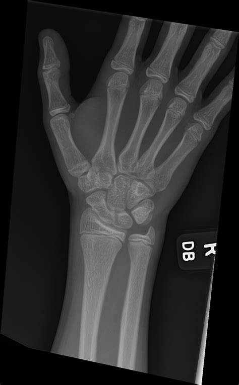 Orthodx Occult Scaphoid Injury Clinical Advisor