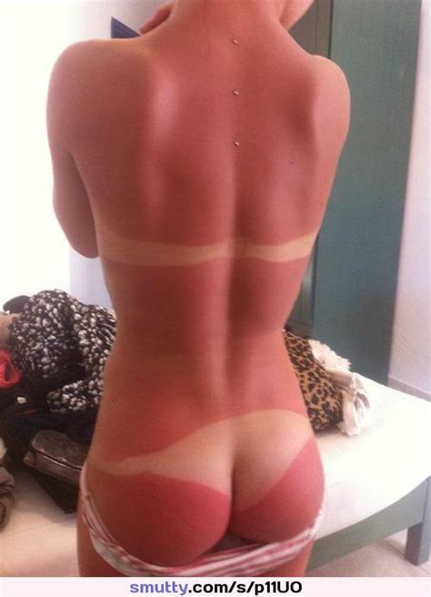 Distracted By The Insanity Ouch Sunburn Tanlines Smutty