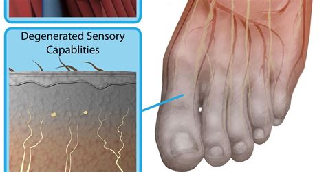 Neuropathy in the feet occurs when the nerve that carries messages to the brain is damaged. Diabetic neuropathy feet pictures | Symptoms and pictures