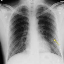 Pneumothorax And Subcutaneous Emphysema CT Radiology At St Vincent S University Hospital