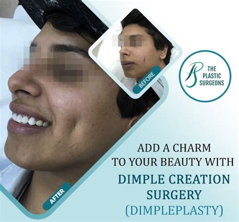 Best Dimple Creation Surgery In Mumbai Dr Vinay Jacob