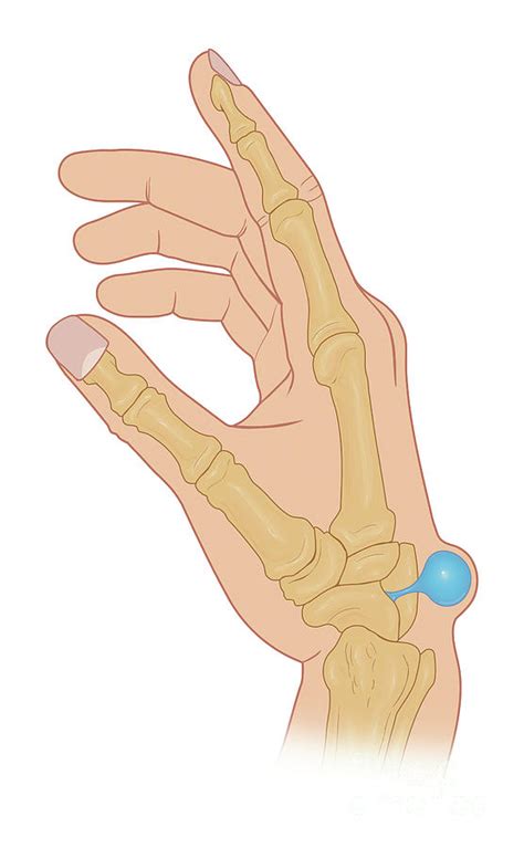 Dorsal Wrist Ganglion Cyst Photograph By Medical Imagery Studios Design Pics Science Photo Library