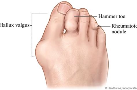 Rheumatoid Arthritis Firefly Foot And Ankle Clinics