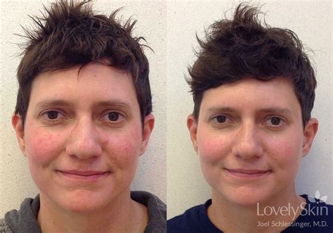 Rosacea Before And After Photos Skin Specialists Pc