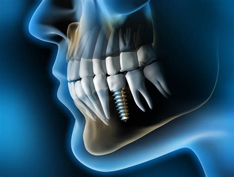 Las 5 Ventajas De Los Implantes Dentales Que No Conocías Daldent