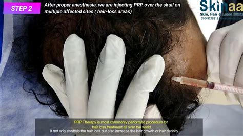 Prp Therapy With Dermaroller For Hair Loss Treatment Re Growth
