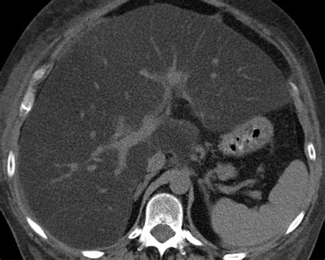 Liver Atlas Diagnosis Steatosis Steatohepatitis