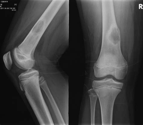 Simple Bone Cyst Combined With Pathologic Fracture Petct