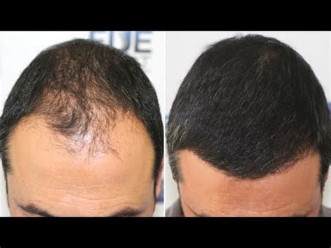 It is an affordable, safe and minimally invasive surgery with good results. FUE Hair Transplant (3825 Grafts NW IV Vertex) By Dr Juan Couto - FUEXPERT CLINIC, Madrid, Spain ...