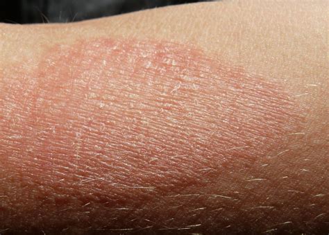 Types Of Eczema Which Are Common