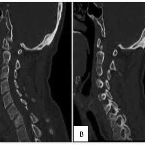 Ct Cervical Spine Fracture Showed Multiple Fractured Vertebrae A
