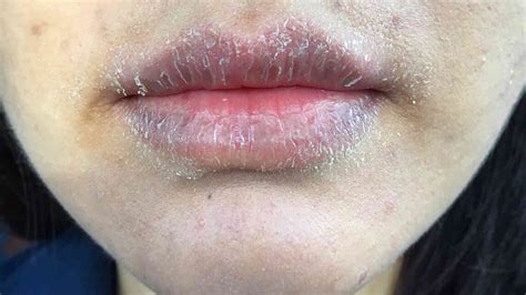 How To Get Rid Of Mango Rash On Lips