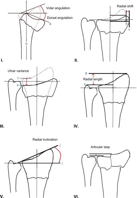 Radiographic Measures Of Outcome In Distal Radius Fractures I Dorsal