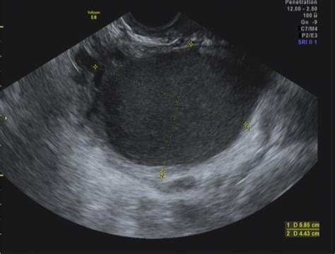 Ovarian Cyst Observed On Transvaginal Ultrasound In A 25 Year Old