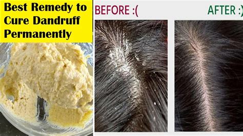In 5 Days Get Rid Of Dandruff Permanently At Home Best Home Remedy To Cure Dandruff Youtube