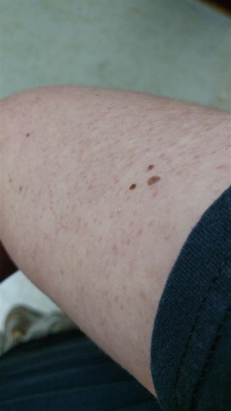 Could This Be From Picking Red Bumps All Over Upper Arms R
