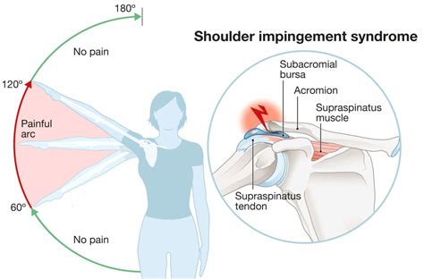 Shoulder Impingement Exercises Emergeortho—triangle Region