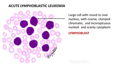 Peripheral Smear Findings In Leukemia Illustrated Pathology Made Simple