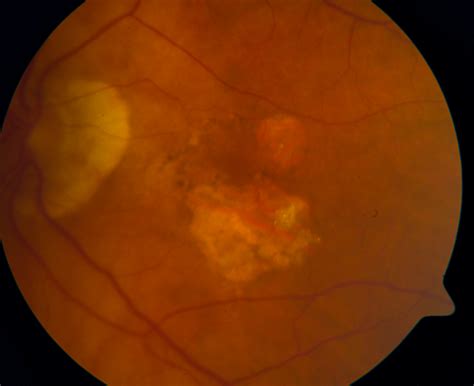 How To Diagnose And Manage Macular Degeneration Eyeguru
