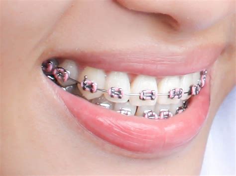 Braces Colors For Teeth