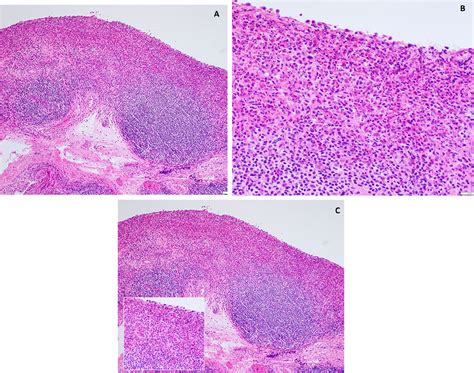 Figure 3 From Refractory Eosinophilic Cystitis Controlled With Low Dose