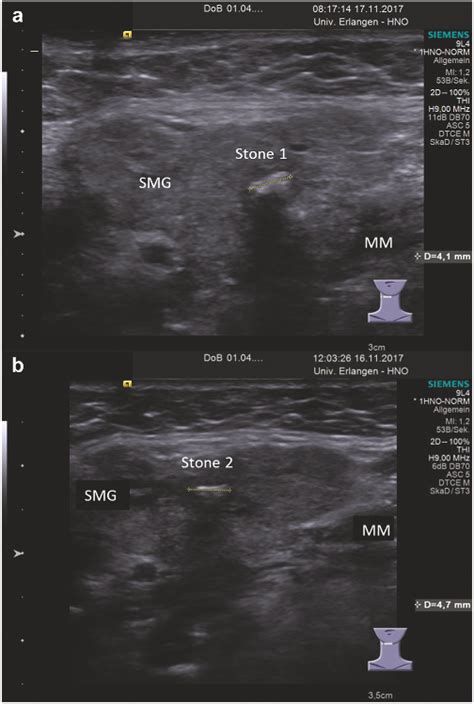 Pdf Intraductal Pneumatic Lithotripsy After Extended Transoral Duct