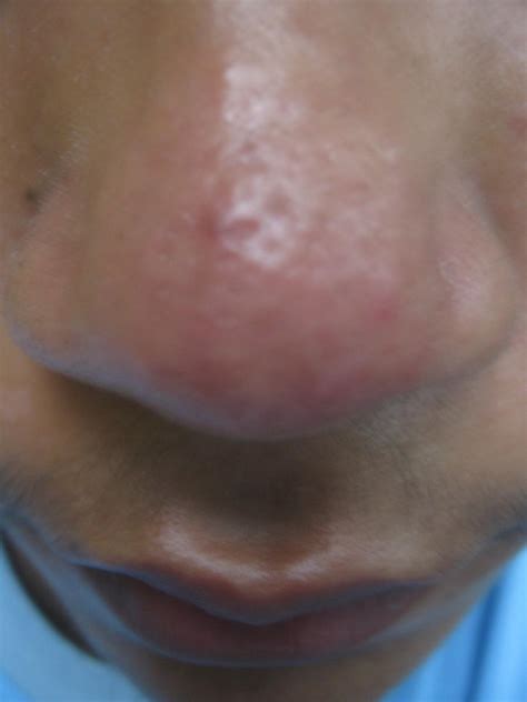Hey How Can I Deal With This On My Nosewith Pics Scar Treatments Forum