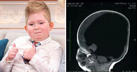 The Child Born With Only 2 Of His Brain Learns To Count And Surf