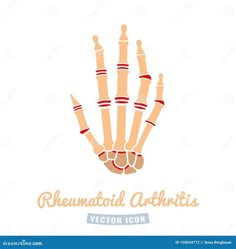 Rheumatoid Arthritis Icon Stock Vector Illustration Of Bone 158034772