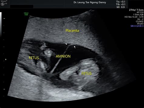 Twins Classification And Diagnosis Hkog Info