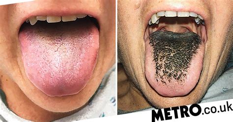 Womans Tongue Suddenly Grows Hairy After She Was Involved In A Crash
