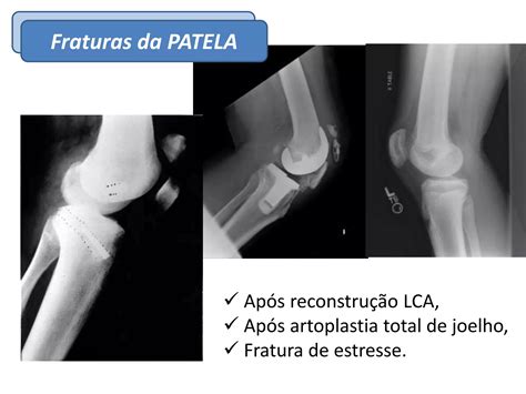 Fratura De Patela