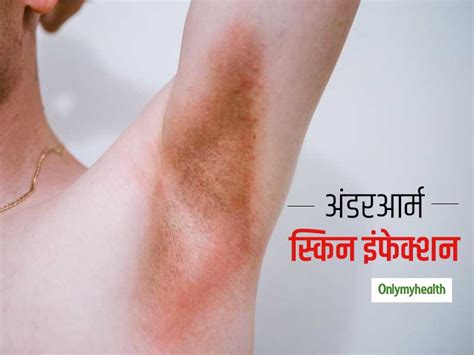 Summer Tips How To Avoid And Treat Underarm Skin Infection Due To