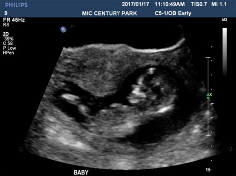 Note, however, that they still may be hard to detect on an ultrasound. Gender guess - 14 week ultrasound - July 2017 - BabyCenter ...