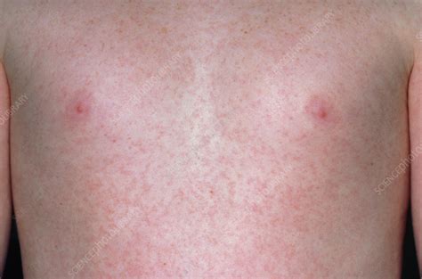 German Measles Rubella Rash On Chest Of A Child Stock Image M210