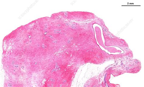 Fibrocystic Breast Change Light Micrograph Stock Image C0510114