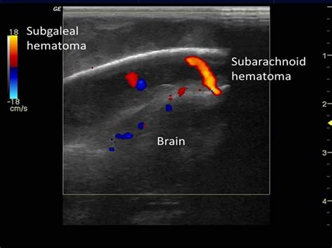 Use Of Color Doppler Ultrasound For The Diagnosis Of Subarachnoid