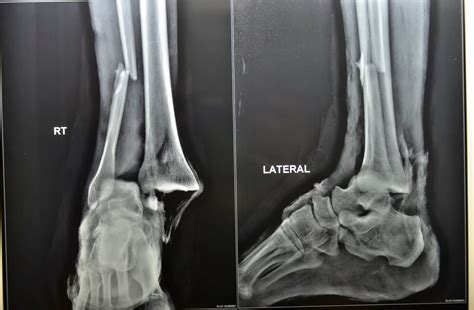 Open Ankle Joint Fracture Dislocation Debridement Free Gracilis