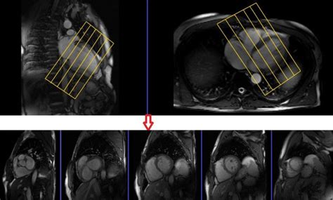 Mri Cardiac Mri Mri Heart