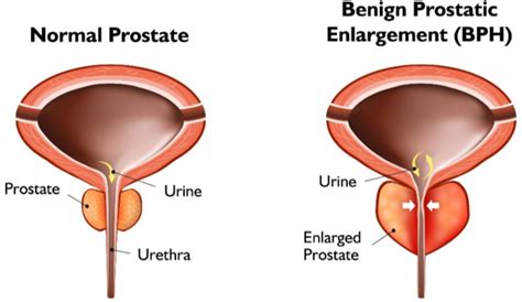 urolift procedure for bph enlarged prostate adult and pediatric urology
