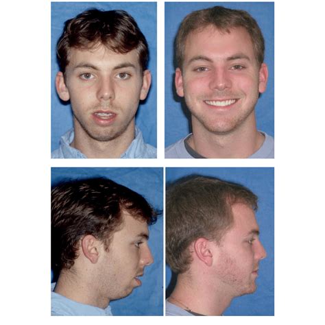 Before And After Photos Maxillofacial Surgery Larry M Wolford Dmd