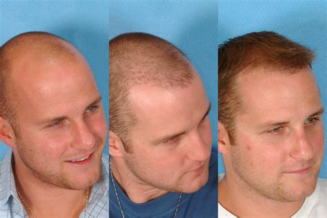 Hair Transplant Before After Ag Hairline Results Flickr