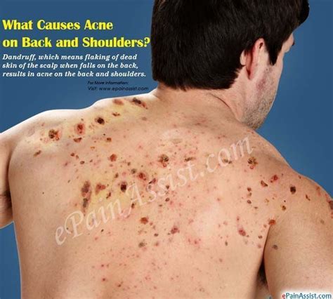 What Causes Acne On Back And Shoulders Hydrogenperoxideacne