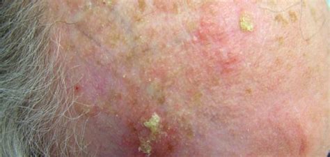 Actinic Keratosis Dorothee Padraig South West Skin Health Care