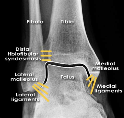 Maisonneuve Fracture Ankle Ankle Fractures Special Situations