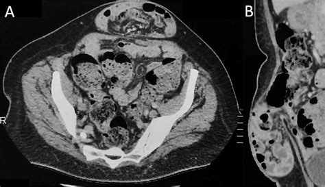 Contrast Enhanced Ct Imaging Demonstrating An Incarcerated Ventral